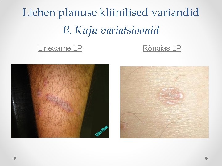 Lichen planuse kliinilised variandid B. Kuju variatsioonid Lineaarne LP Rõngjas LP 