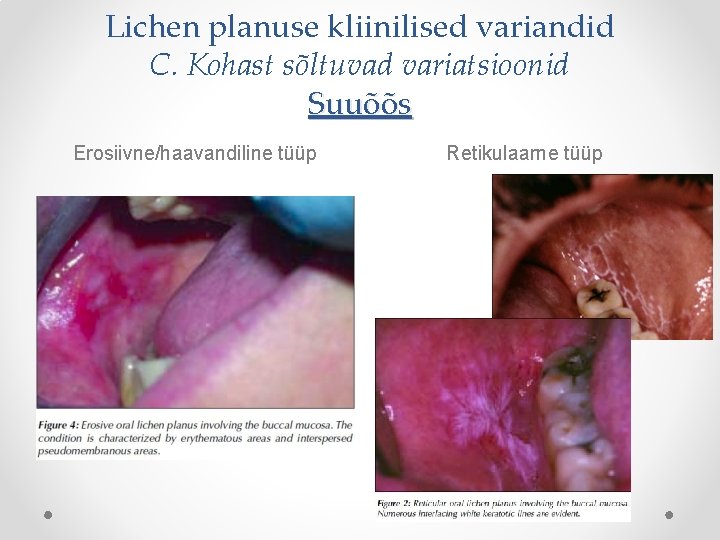 Lichen planuse kliinilised variandid C. Kohast sõltuvad variatsioonid Suuõõs Erosiivne/haavandiline tüüp Retikulaarne tüüp 