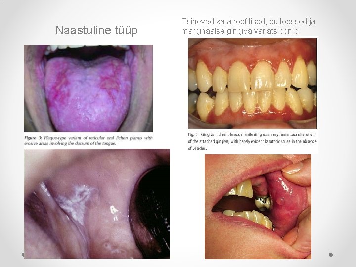 Naastuline tüüp Esinevad ka atroofilised, bulloossed ja marginaalse gingiva variatsioonid. 