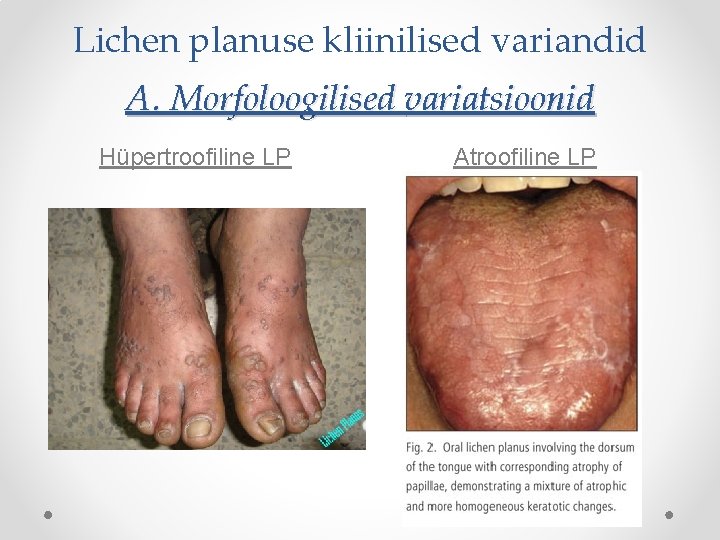 Lichen planuse kliinilised variandid A. Morfoloogilised variatsioonid Hüpertroofiline LP Atroofiline LP 