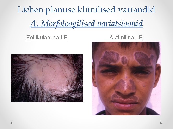 Lichen planuse kliinilised variandid A. Morfoloogilised variatsioonid Follikulaarne LP Aktiiniline LP 