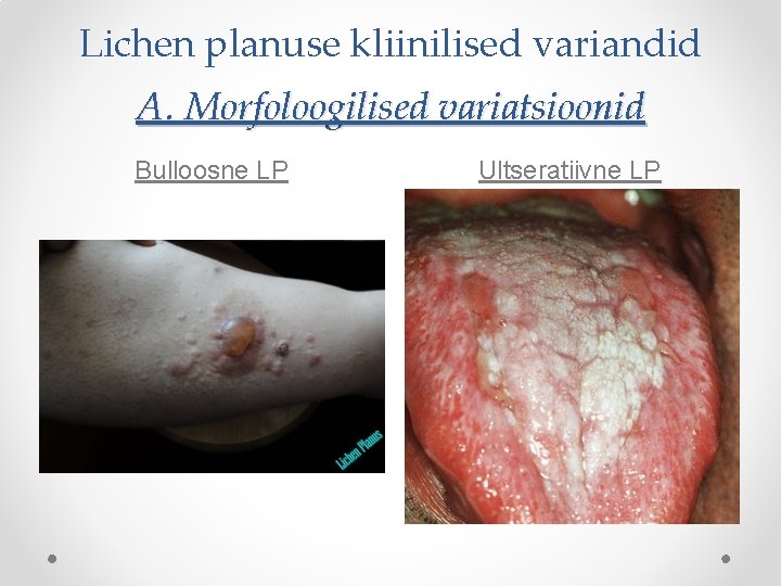 Lichen planuse kliinilised variandid A. Morfoloogilised variatsioonid Bulloosne LP Ultseratiivne LP 