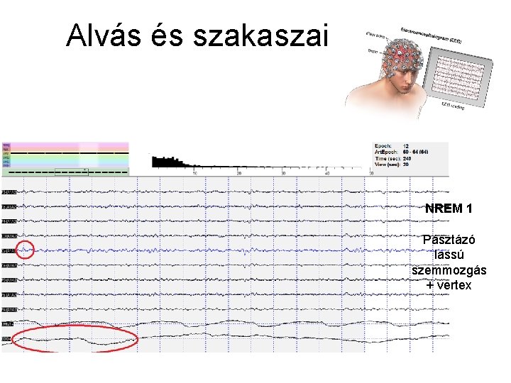 Alvás és szakaszai NREM 1 Pásztázó lassú szemmozgás + vertex 