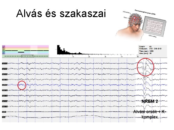 Alvás és szakaszai NREM 2 Alvási orsók + Kkomplex 