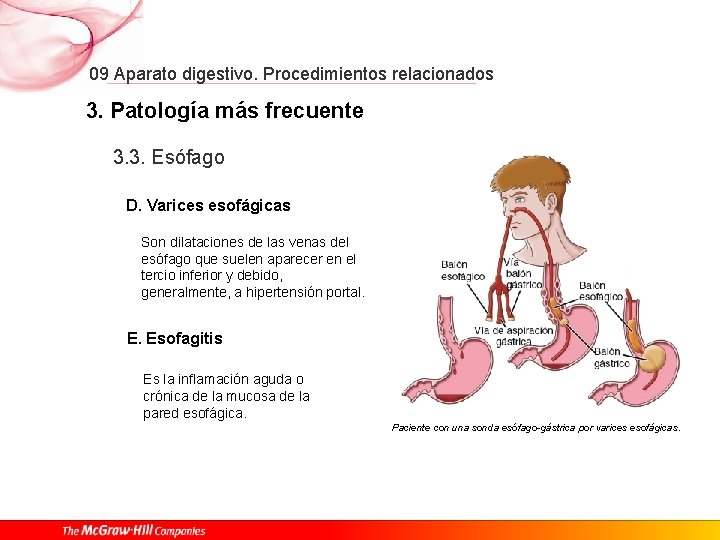 09 Aparato digestivo. Procedimientos relacionados 3. Patología más frecuente 3. 3. Esófago D. Varices