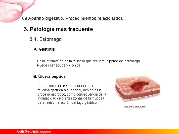 09 Aparato digestivo. Procedimientos relacionados 3. Patología más frecuente 3. 4. Estómago A. Gastritis