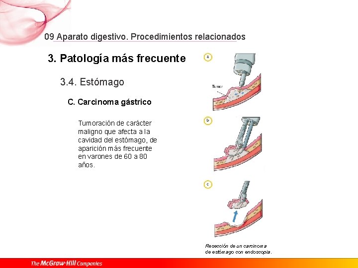 09 Aparato digestivo. Procedimientos relacionados 3. Patología más frecuente 3. 4. Estómago C. Carcinoma