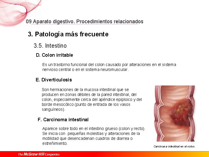 09 Aparato digestivo. Procedimientos relacionados 3. Patología más frecuente 3. 5. Intestino D. Colon