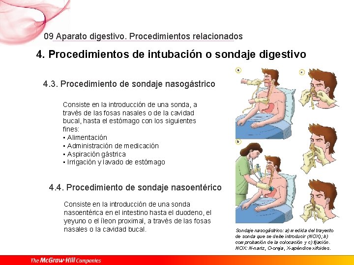 09 Aparato digestivo. Procedimientos relacionados 4. Procedimientos de intubación o sondaje digestivo 4. 3.