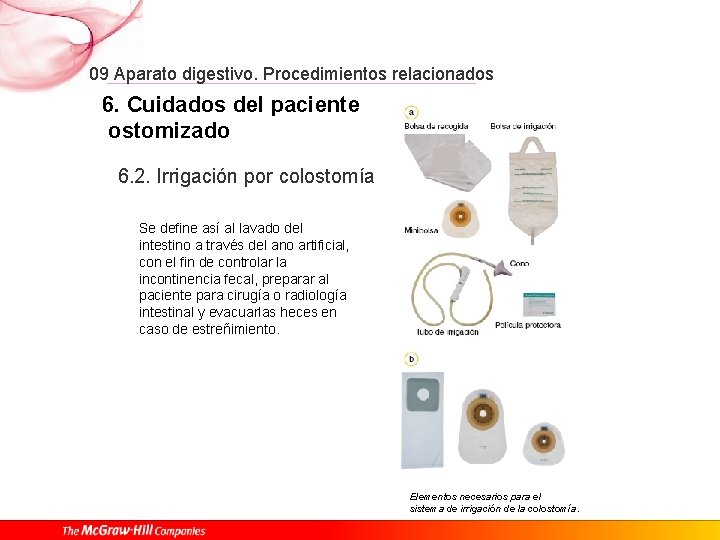 09 Aparato digestivo. Procedimientos relacionados 6. Cuidados del paciente ostomizado 6. 2. Irrigación por