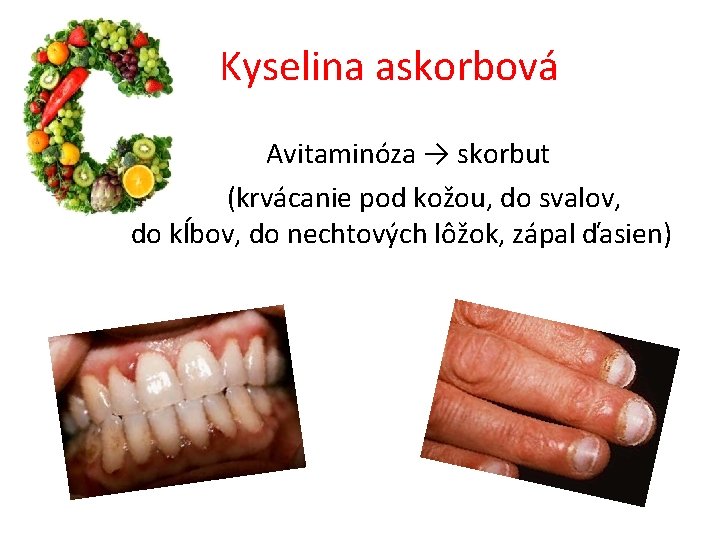 Kyselina askorbová Avitaminóza → skorbut (krvácanie pod kožou, do svalov, do kĺbov, do nechtových