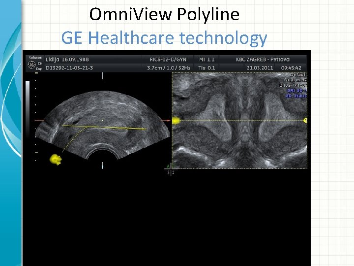 Omni. View Polyline GE Healthcare technology 