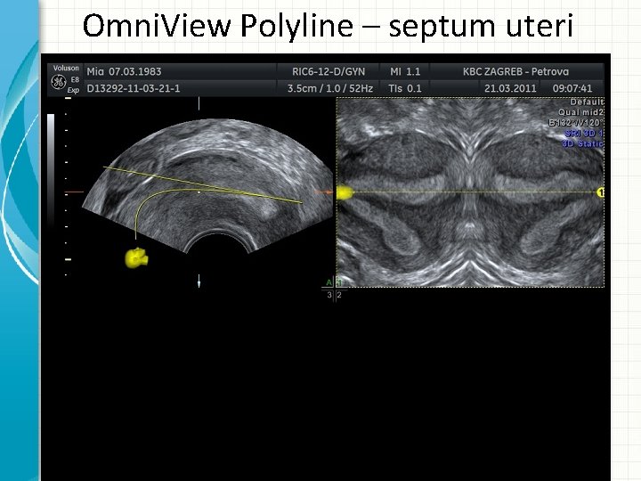 Omni. View Polyline – septum uteri 
