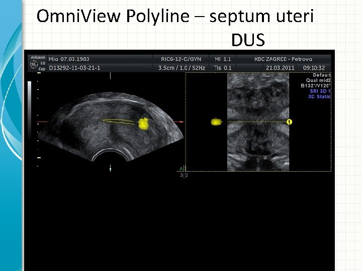 Omni. View Polyline – septum uteri DUS 