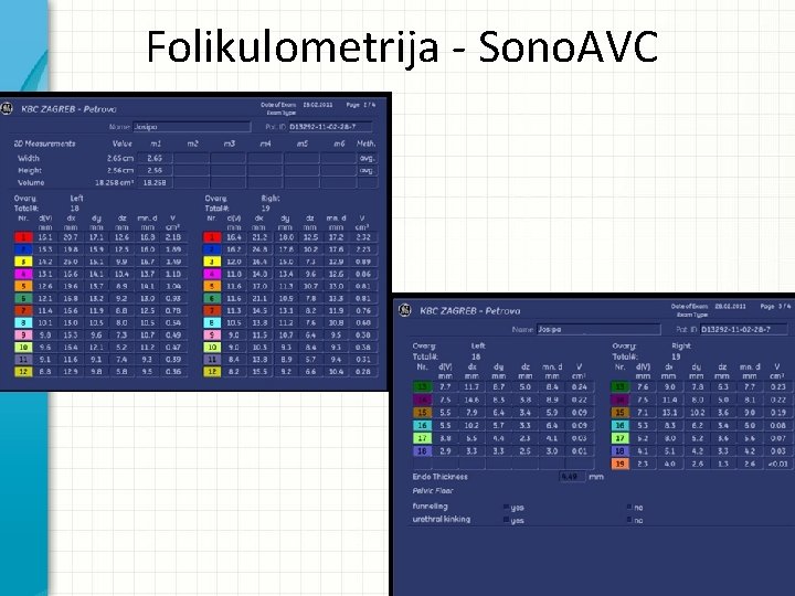 Folikulometrija - Sono. AVC 