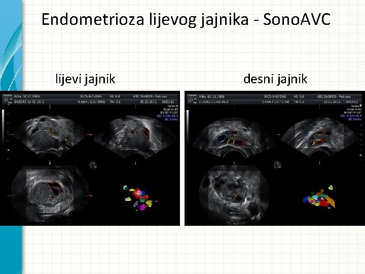 Endometrioza lijevog jajnika - Sono. AVC lijevi jajnik desni jajnik 