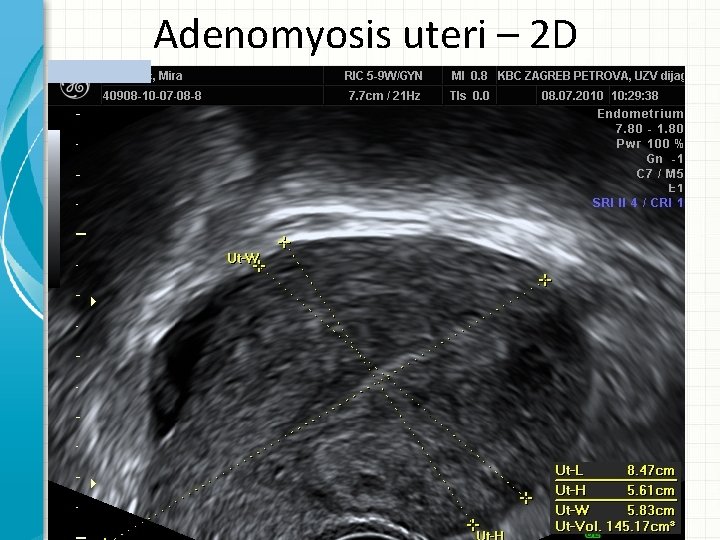 Adenomyosis uteri – 2 D 