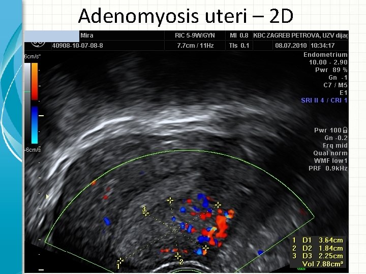 Adenomyosis uteri – 2 D 