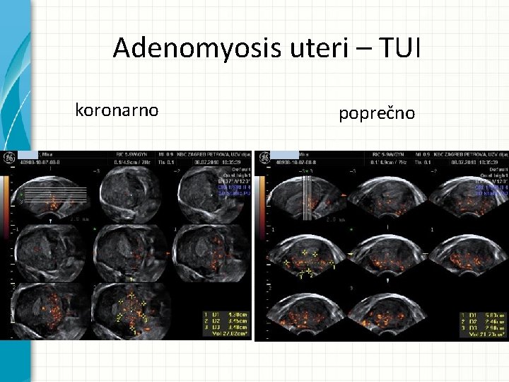 Adenomyosis uteri – TUI koronarno poprečno 