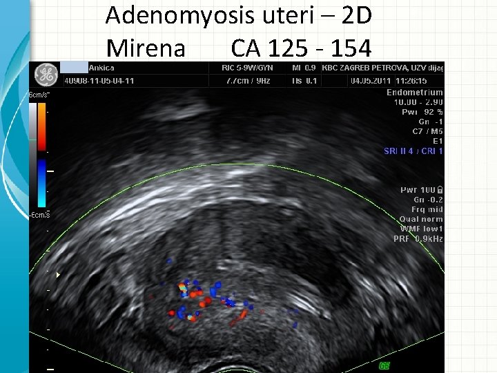 Adenomyosis uteri – 2 D Mirena CA 125 - 154 