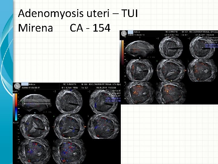 Adenomyosis uteri – TUI Mirena CA - 154 