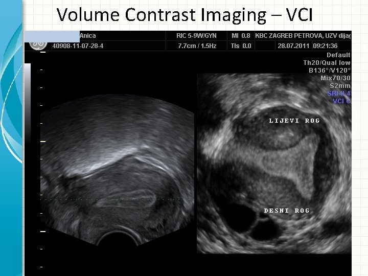 Volume Contrast Imaging – VCI 