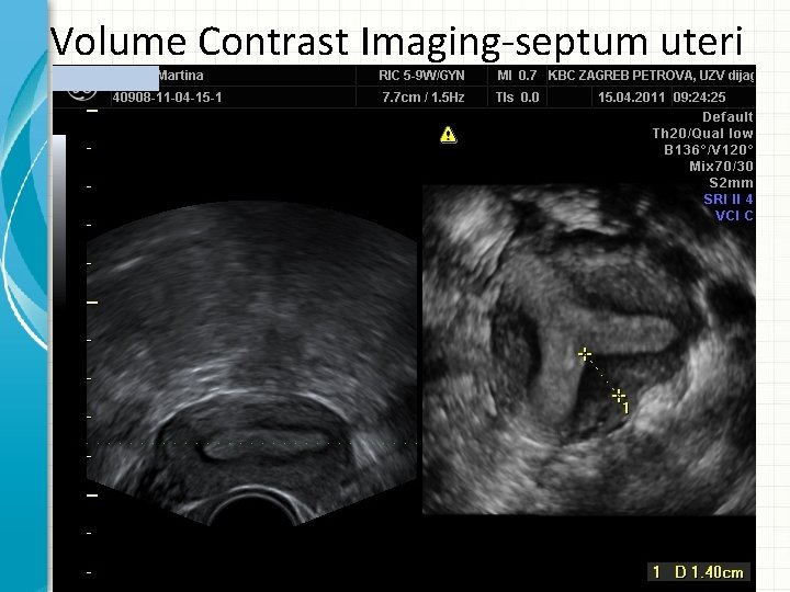 Volume Contrast Imaging-septum uteri 