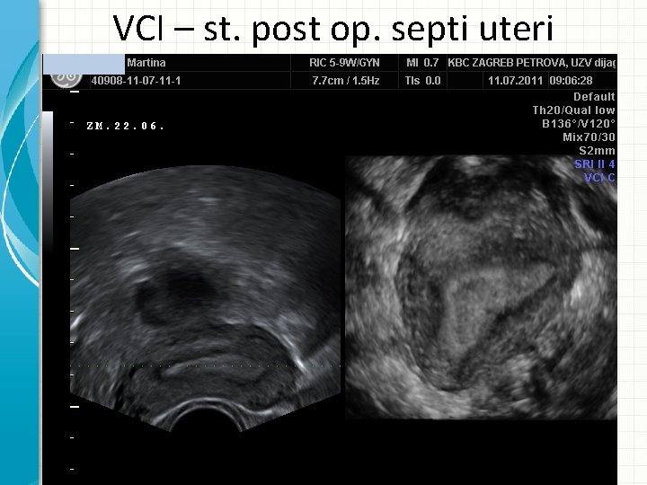 VCI – st. post op. septi uteri 