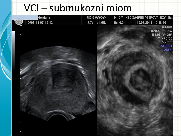 VCI – submukozni miom 