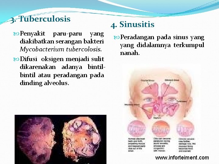 3. Tuberculosis Penyakit paru-paru yang diakibatkan serangan bakteri Mycobacterium tubercolosis. Difusi oksigen menjadi sulit