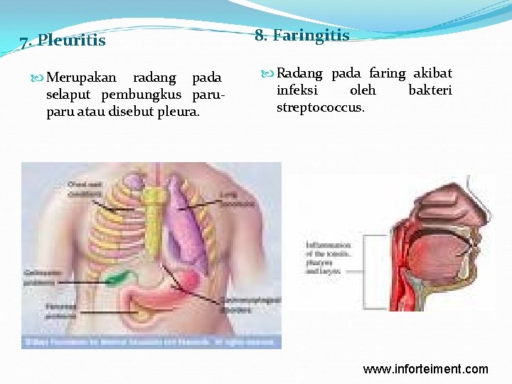 7. Pleuritis Merupakan radang pada selaput pembungkus paru atau disebut pleura. 8. Faringitis Radang