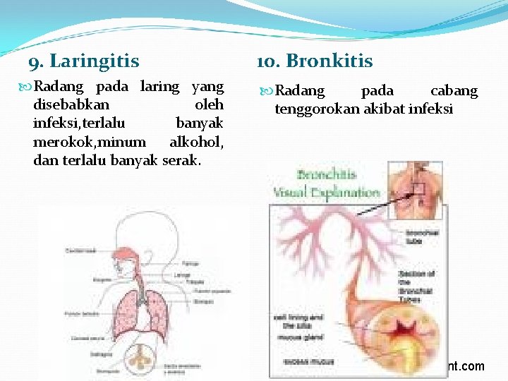 9. Laringitis Radang pada laring yang disebabkan oleh infeksi, terlalu banyak merokok, minum alkohol,