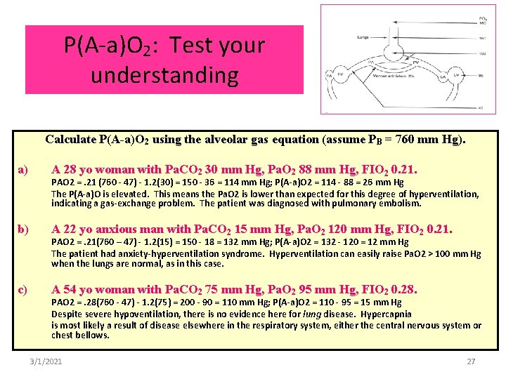 P(A-a)O 2: Test your understanding Calculate P(A-a)O 2 using the alveolar gas equation (assume