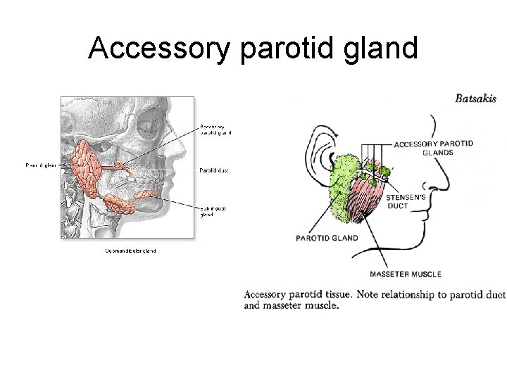 Accessory parotid gland 