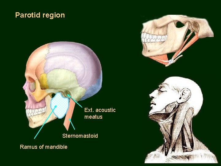 Parotid region Ext. acoustic meatus Sternomastoid Ramus of mandible 