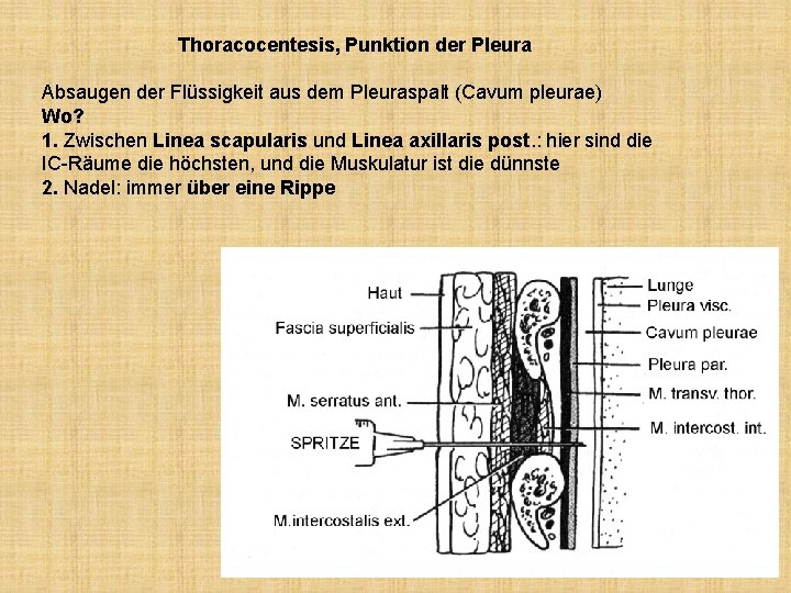 Thoracocentesis, Punktion der Pleura Absaugen der Flüssigkeit aus dem Pleuraspalt (Cavum pleurae) Wo? 1.