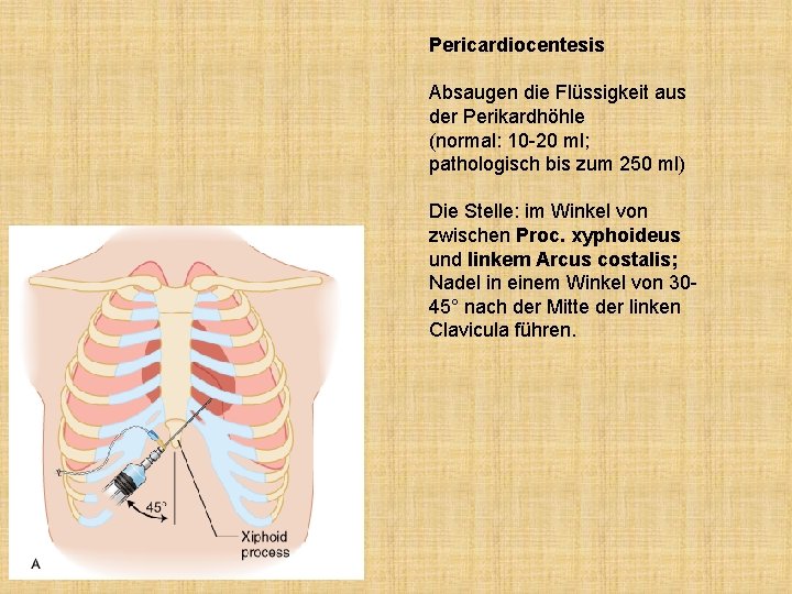 Pericardiocentesis Absaugen die Flüssigkeit aus der Perikardhöhle (normal: 10 -20 ml; pathologisch bis zum