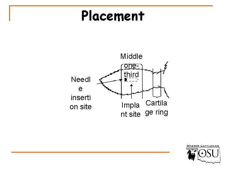 Placement Needl e inserti on site Middle onethird Impla Cartila nt site ge ring
