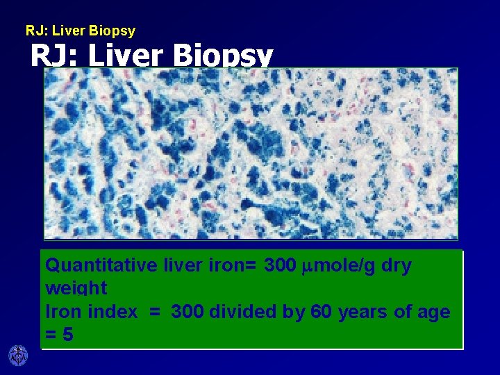 RJ: Liver Biopsy Quantitative liver iron= 300 mmole/g dry weight Iron index = 300