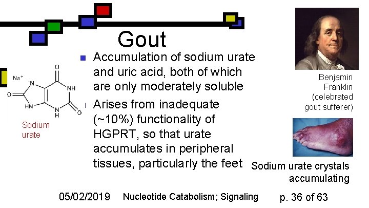 Gout n n Sodium urate Accumulation of sodium urate and uric acid, both of