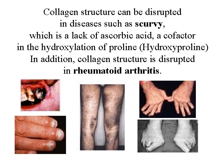 Collagen structure can be disrupted in diseases such as scurvy, which is a lack