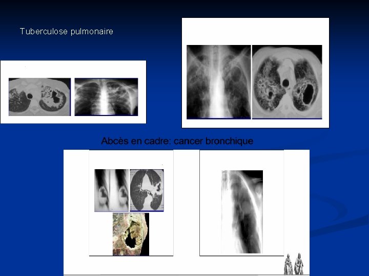 Tuberculose pulmonaire 