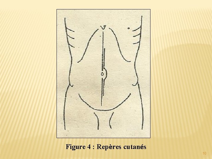 Figure 4 : Repères cutanés 10 