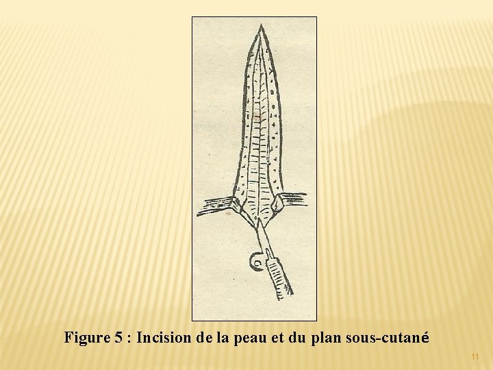 Figure 5 : Incision de la peau et du plan sous-cutané 11 