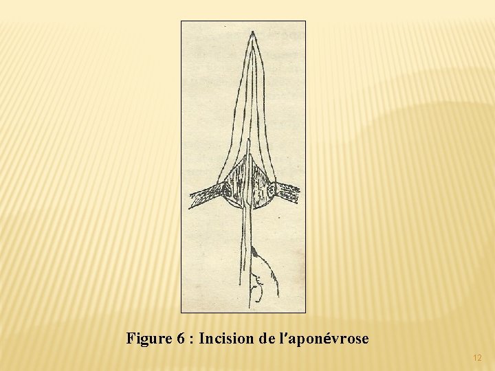 Figure 6 : Incision de l’aponévrose 12 