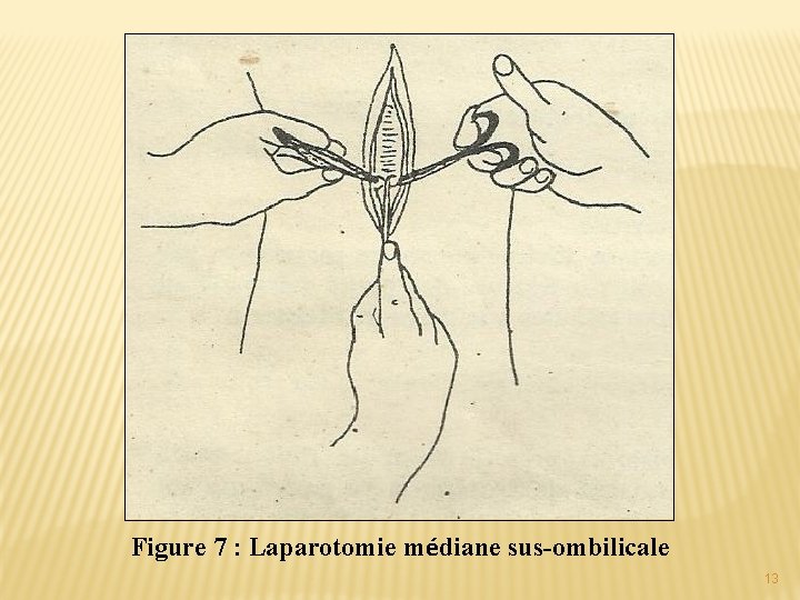 Figure 7 : Laparotomie médiane sus-ombilicale 13 