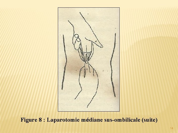 Figure 8 : Laparotomie médiane sus-ombilicale (suite) 14 