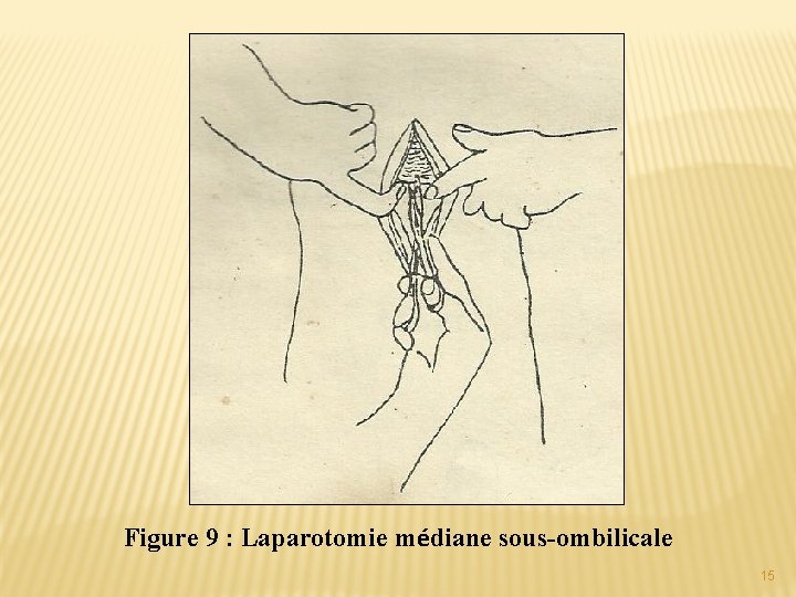 Figure 9 : Laparotomie médiane sous-ombilicale 15 