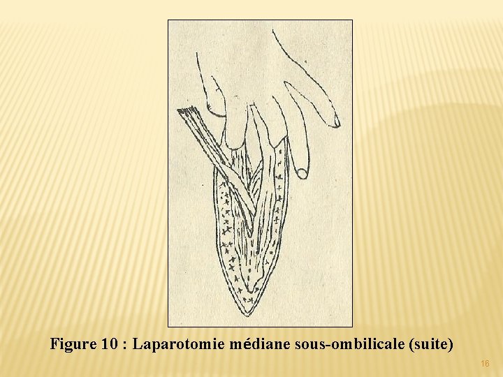 Figure 10 : Laparotomie médiane sous-ombilicale (suite) 16 