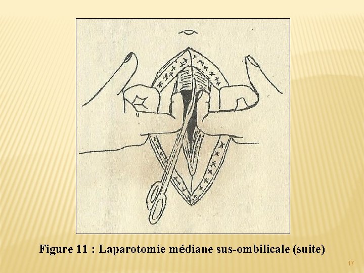 Figure 11 : Laparotomie médiane sus-ombilicale (suite) 17 